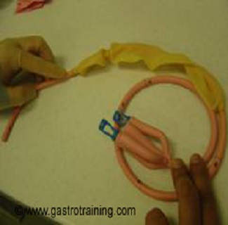 Sengstaken Esophageal Balloon